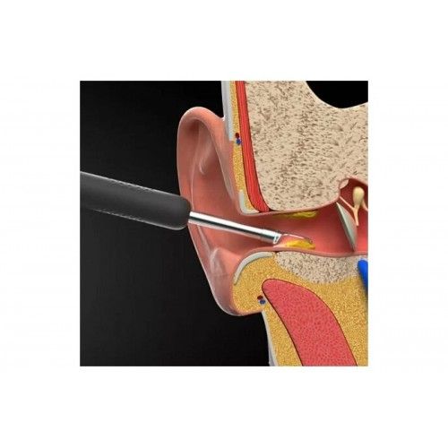 Умная ушная палочка Bebird Smart Visual Spoon Ear Stick R1 (черный)